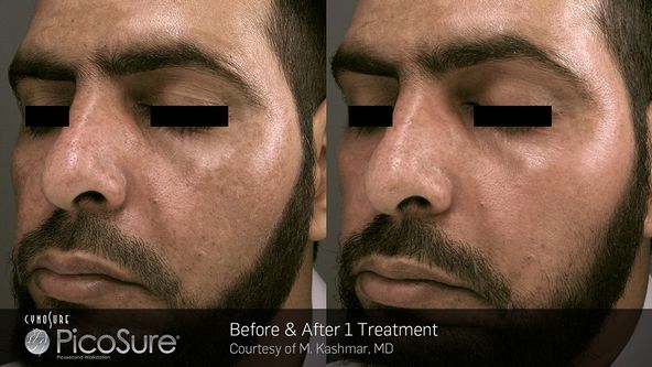 tn_BA_PicoSure_M.-KashMar_Post1Tx_pigment_web1