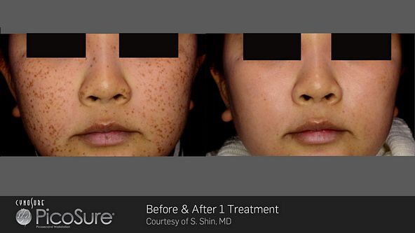 tn_BA_PicoSure_SShin_Post1Tx_pigment_web1