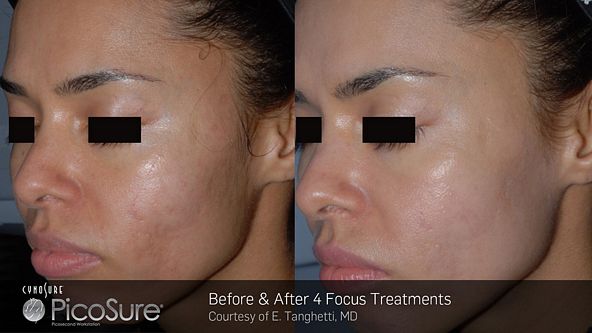 tn_BA_PicoSure_Tanghetti_Post4Tx_Acne_web1