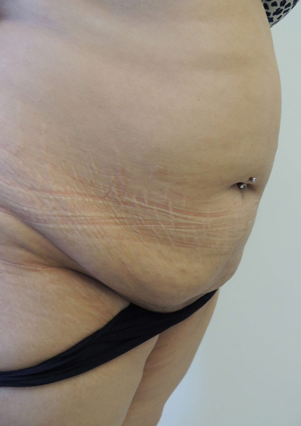 Lipo-corps001-1