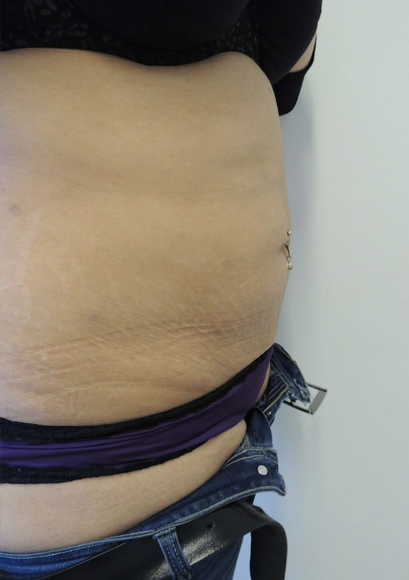 Lipo-corps001-2