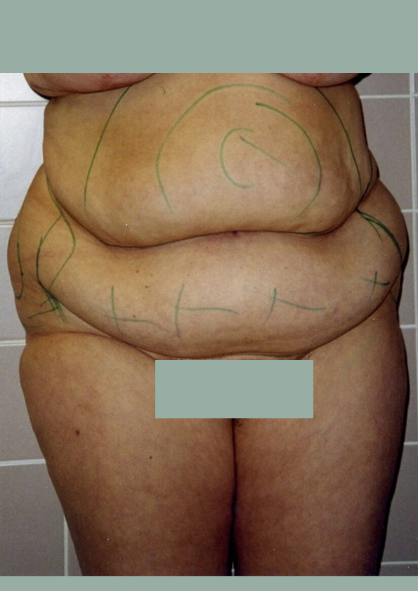 Lipo-corps002-1