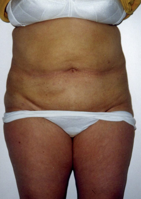 Lipo-corps002-2