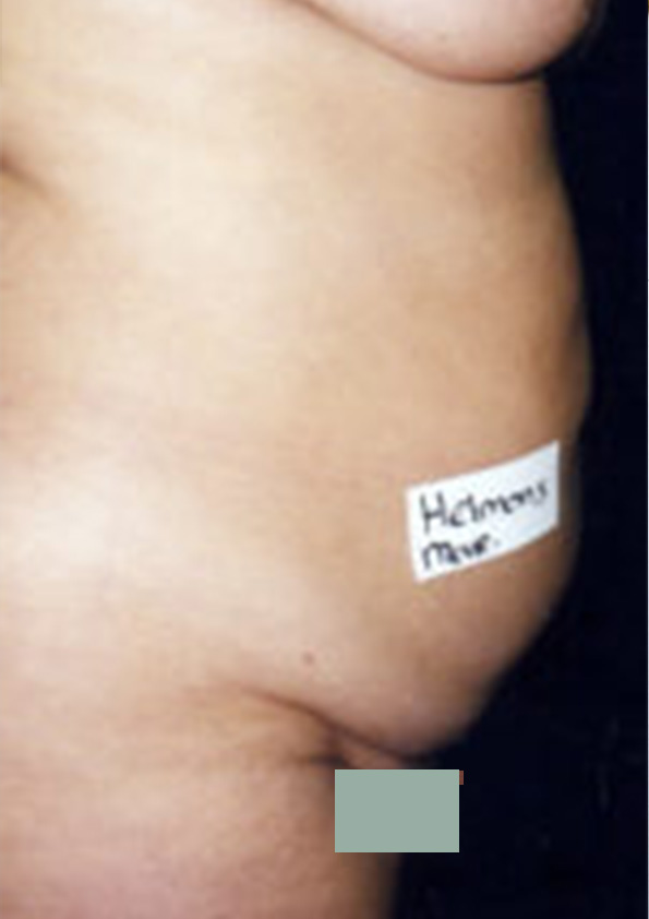 Lipo-corps003-1