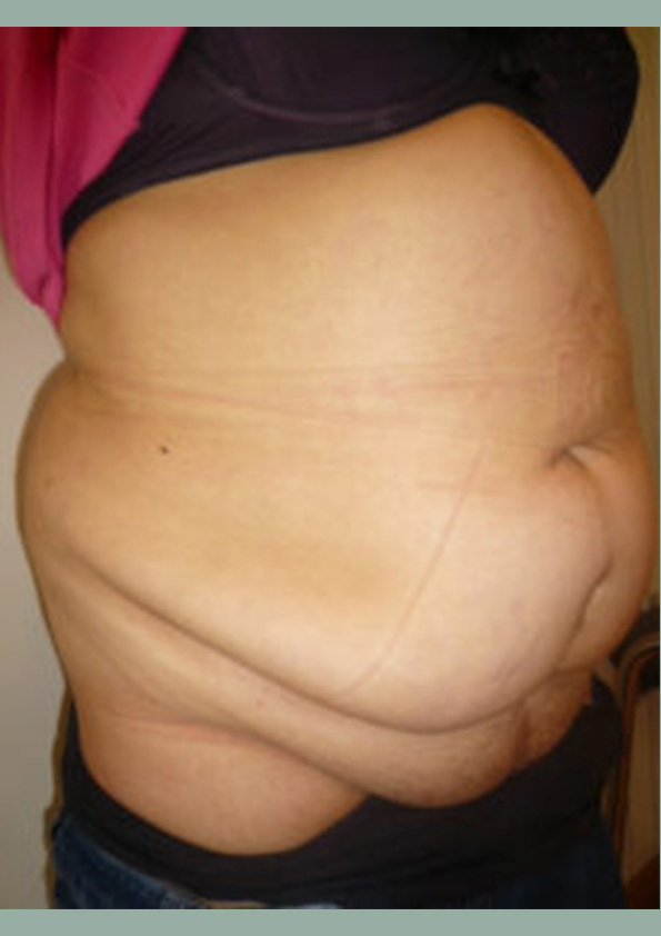 Lipo-corps004-1