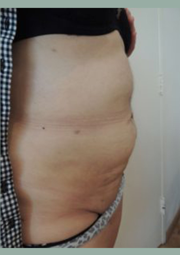 Lipo-corps004-2