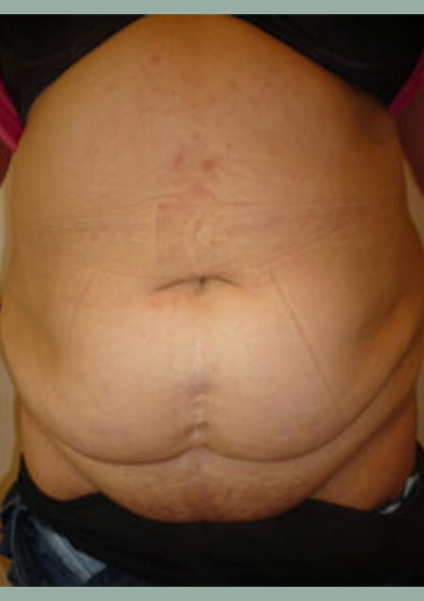 Lipo-corps005-1
