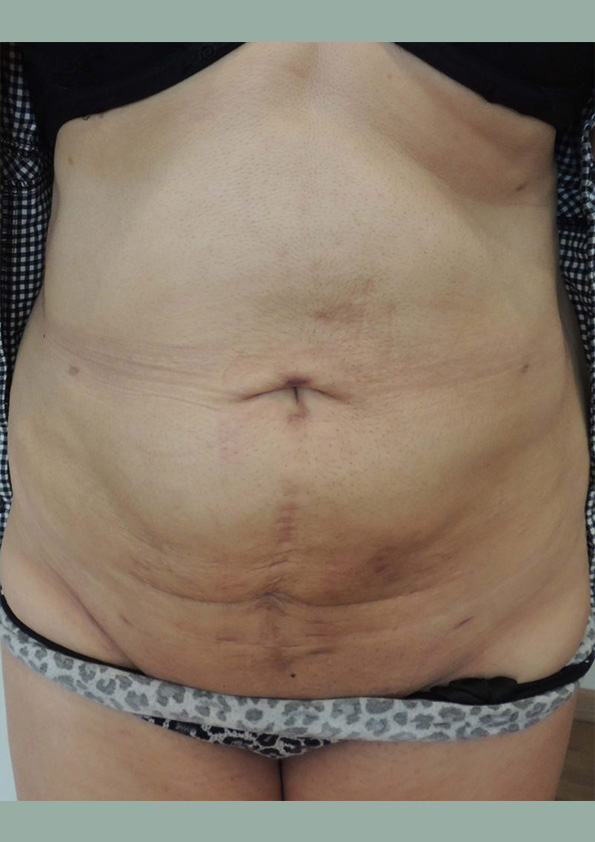 Lipo-corps005-2