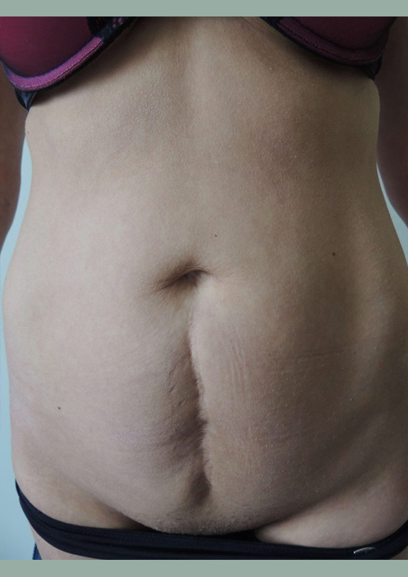 Lipo-corps006-1