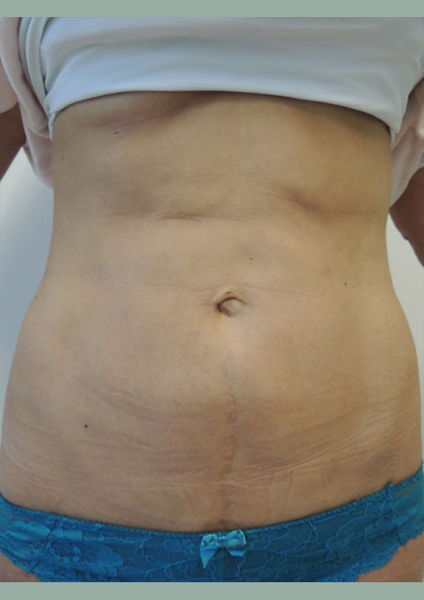 Lipo-corps006-2