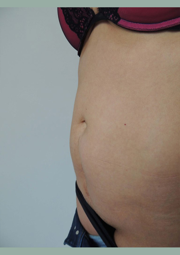 Lipo-corps007-1