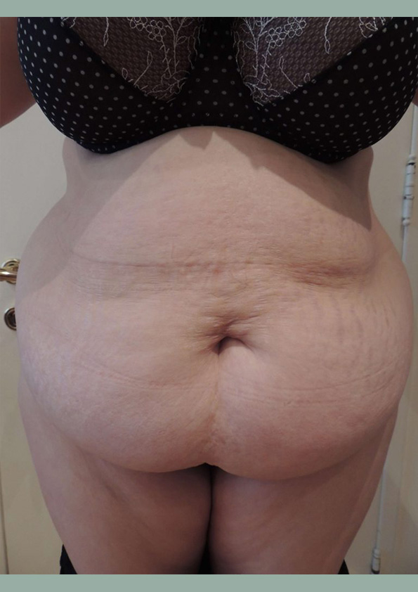 Lipo-corps008-1