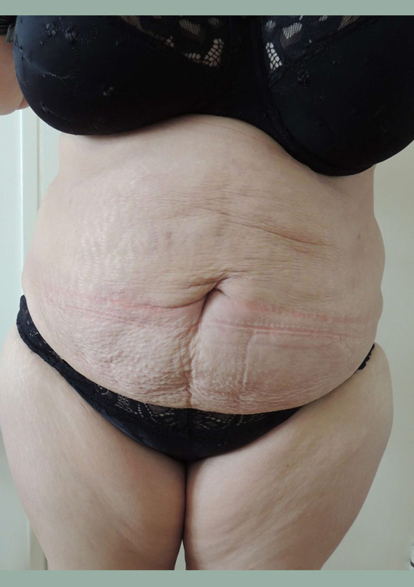 Lipo-corps008-2