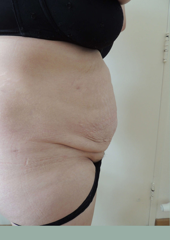 Lipo-corps009-1