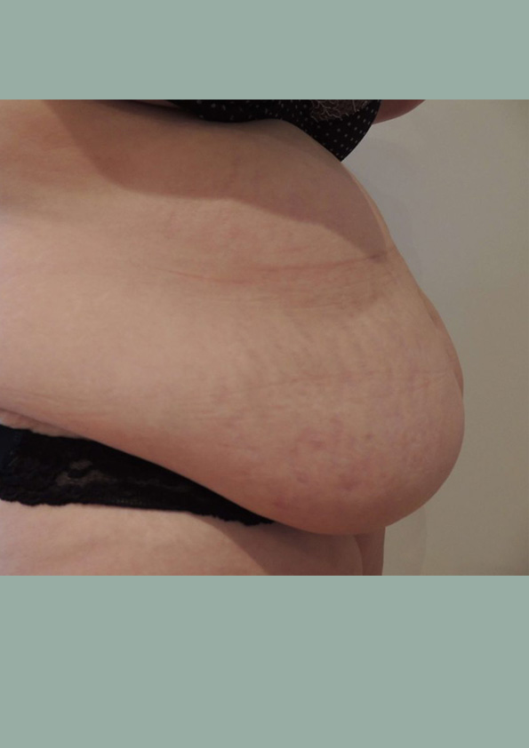 Lipo-corps009-2