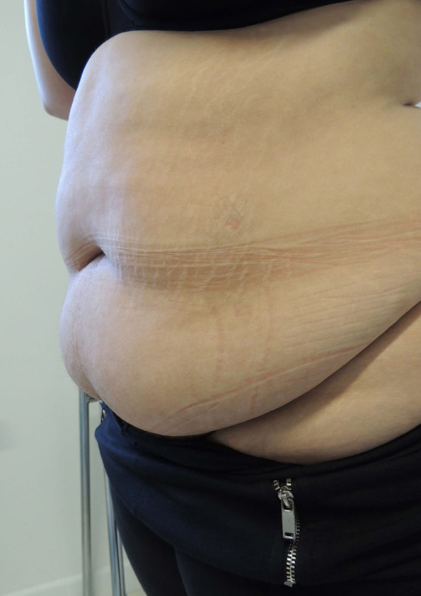 Lipo-corps010-1
