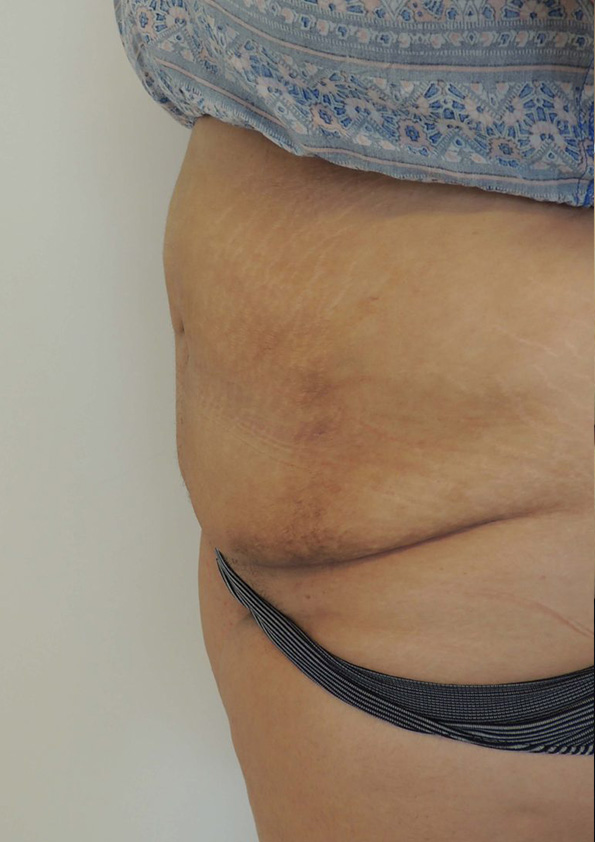 Lipo-corps010-2