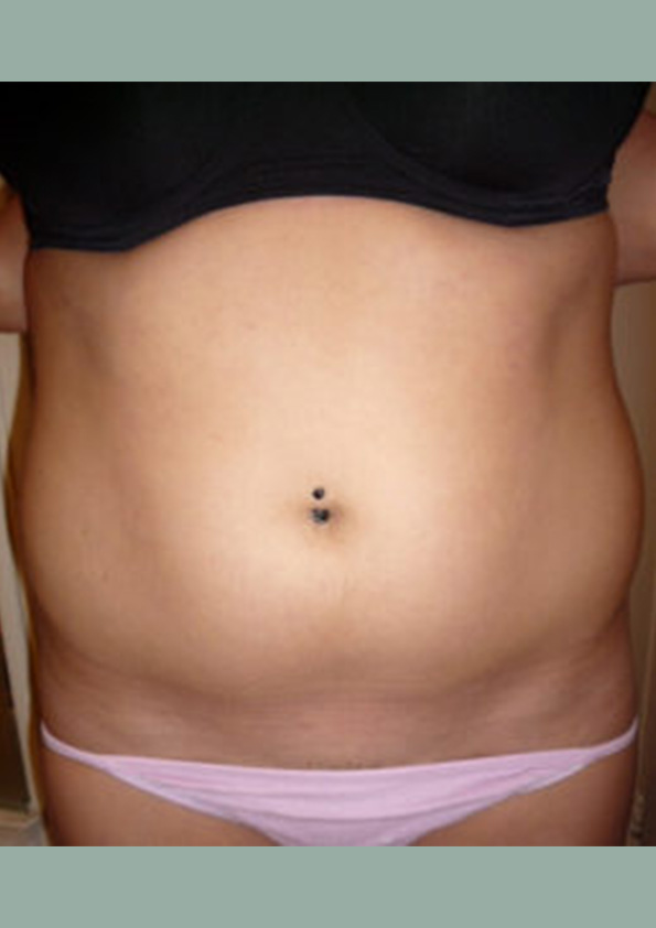 Lipo-corps011-1