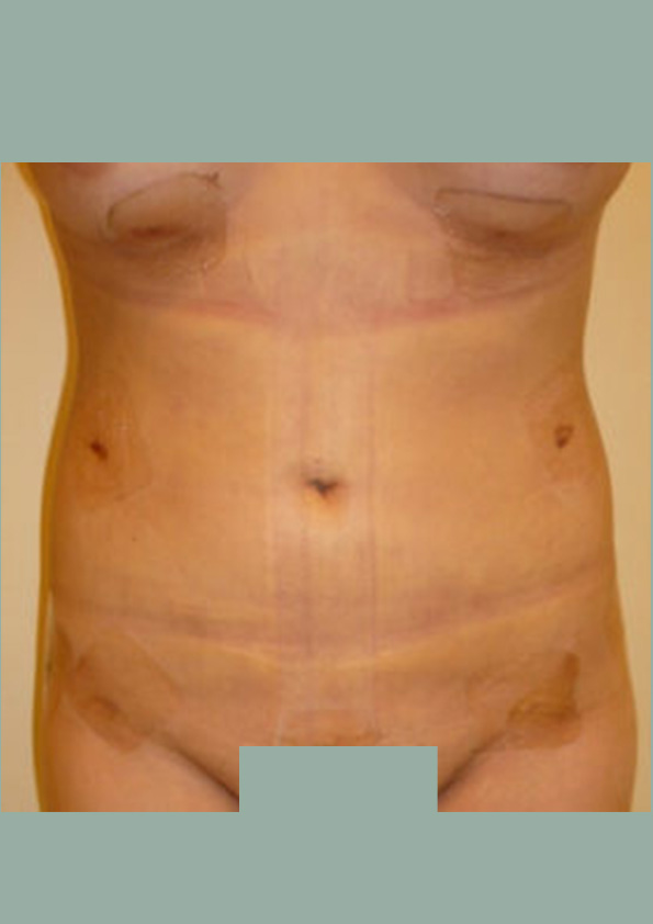 Lipo-corps011-2