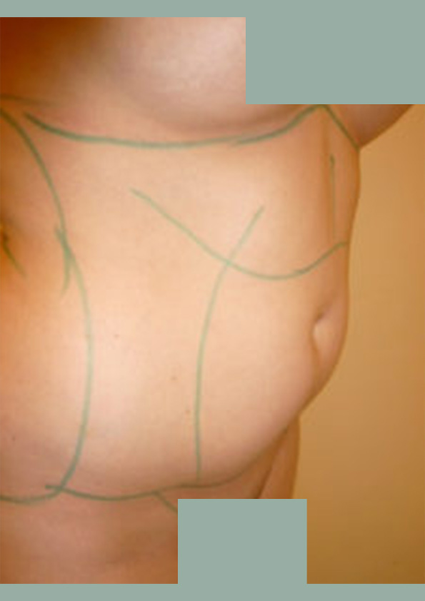 Lipo-corps012-1