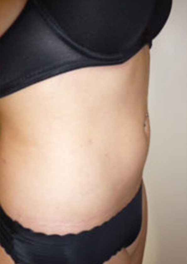 Lipo-corps012-2