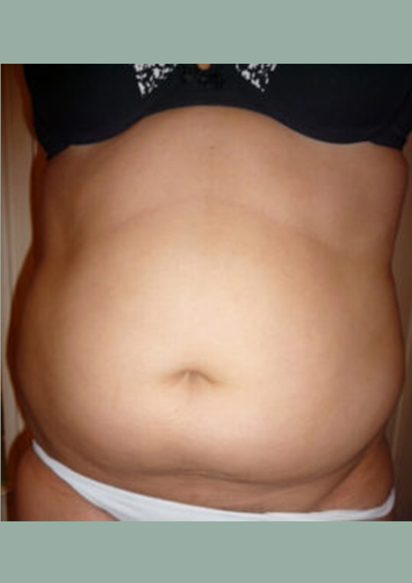 Lipo-corps013-1