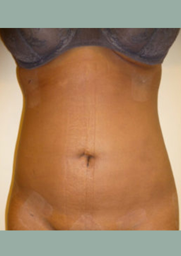 Lipo-corps013-2