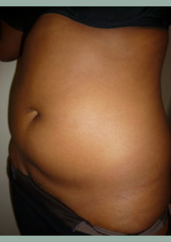 Lipo-corps014-1