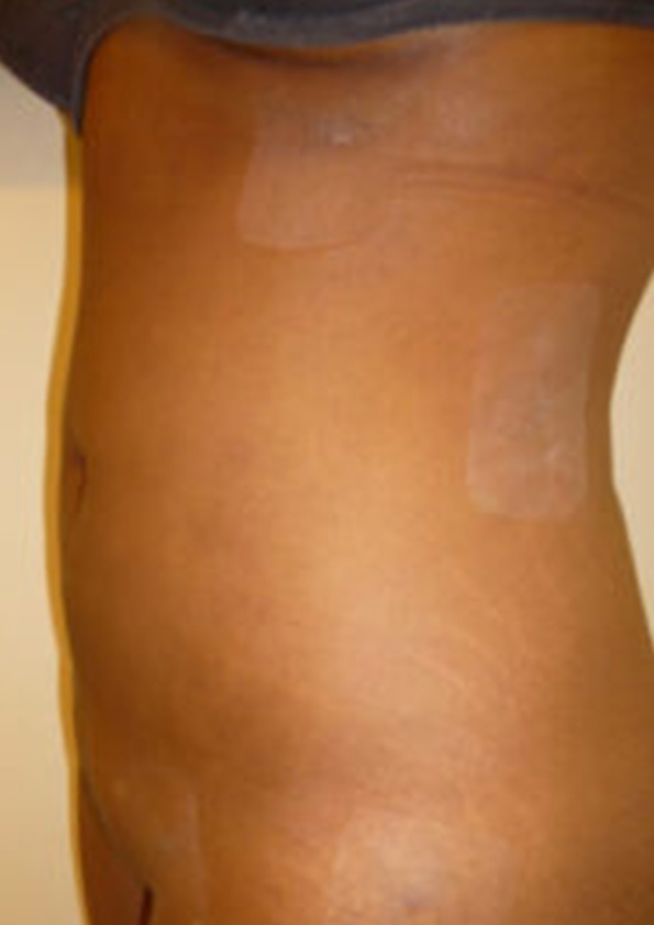 Lipo-corps014-2
