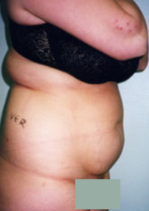 Lipo-corps015-1