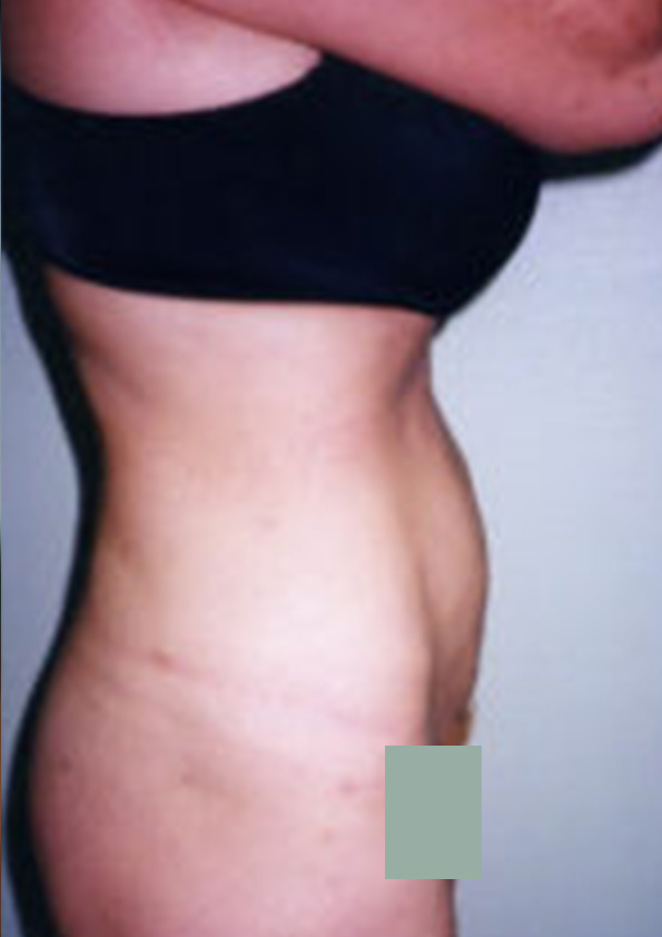 Lipo-corps015-2