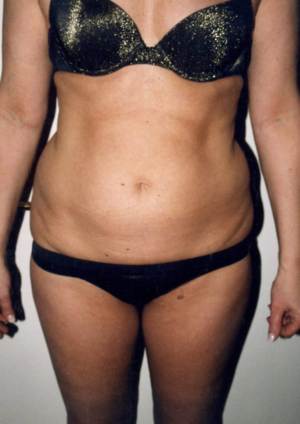 Lipo-corps016-1