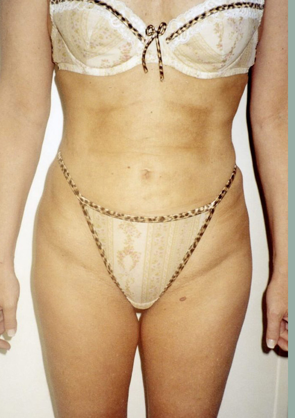 Lipo-corps016-2