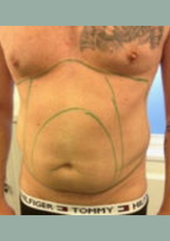 Lipo-corps017-1