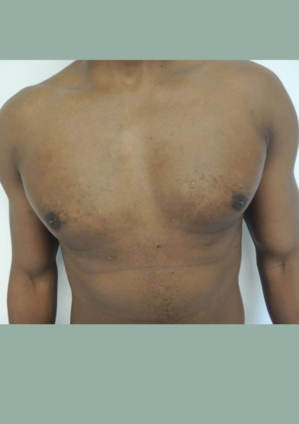 Lipo-corps018-2