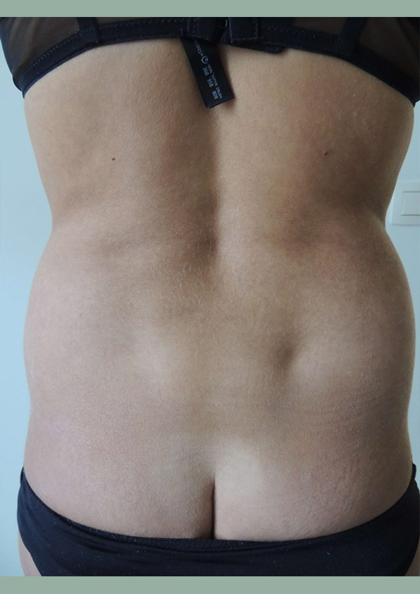Lipo-corps019-1
