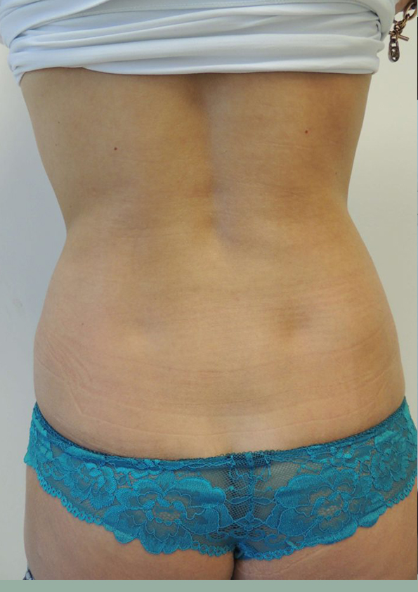 Lipo-corps019-2