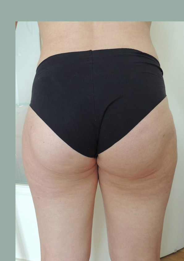Lipo-corps020-2