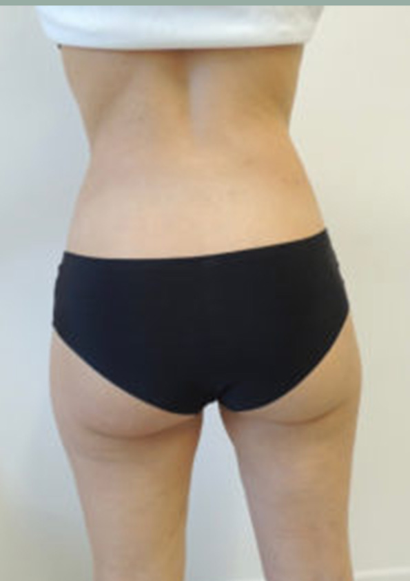 Lipo-corps023-2