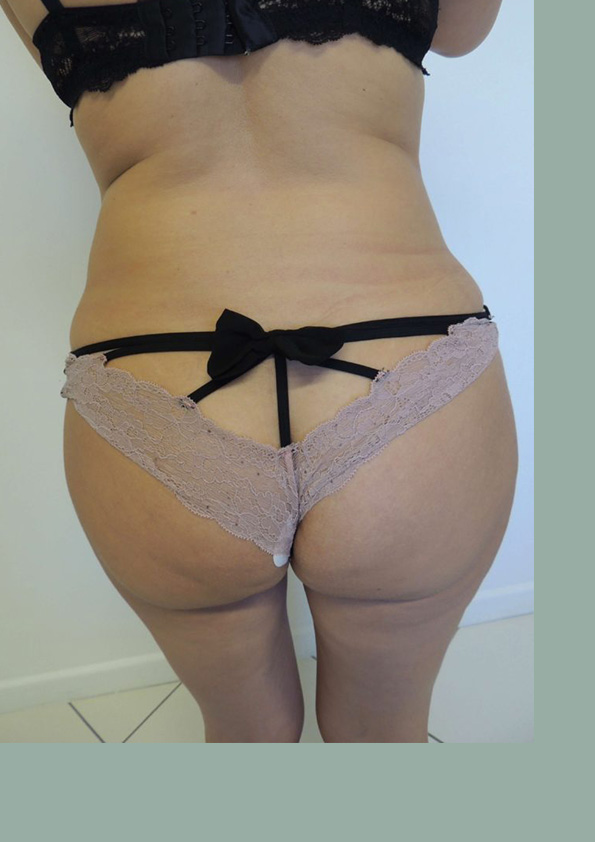 Lipo-corps024-1