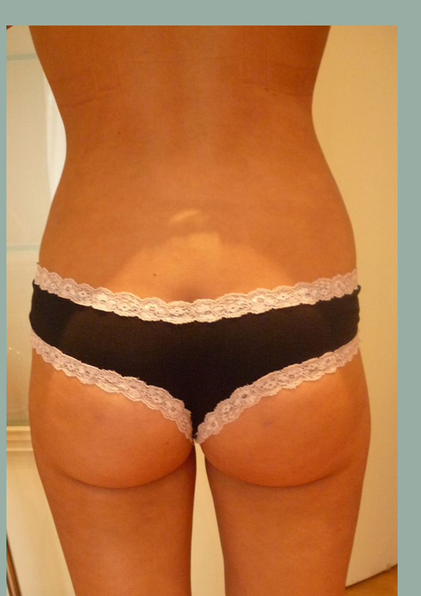 Lipo-corps025-2