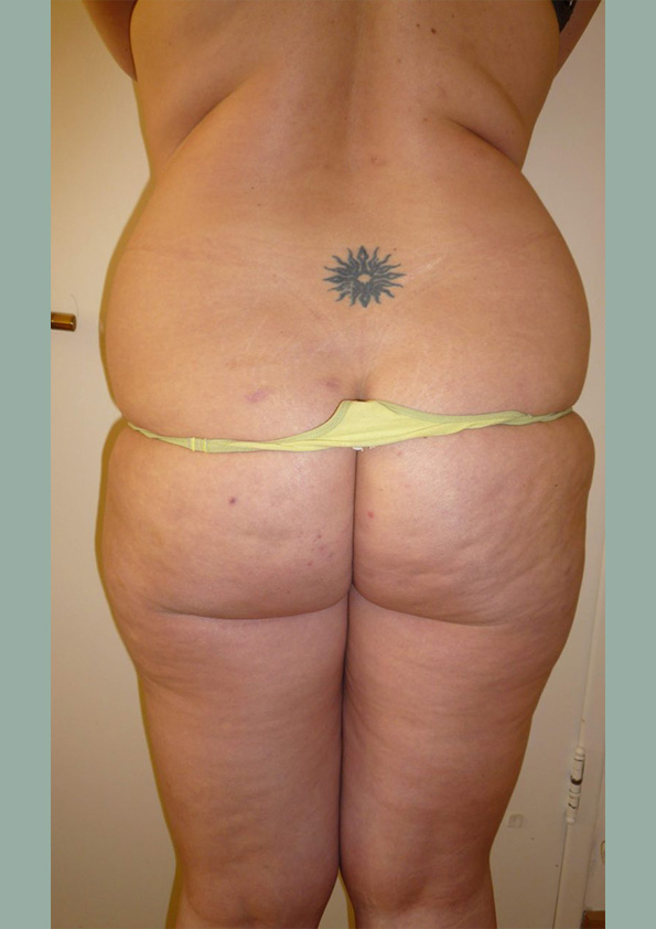 Lipo-corps026-1
