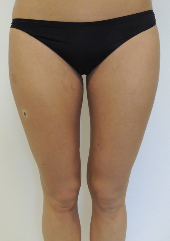 Lipo-corps028-2