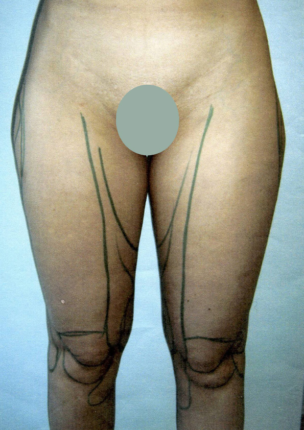 Lipo-corps029-1