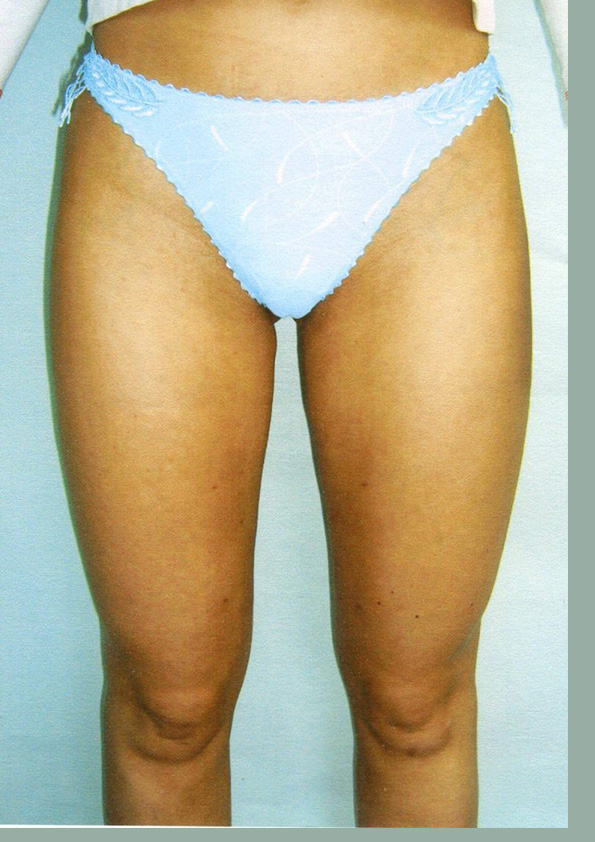 Lipo-corps029-2