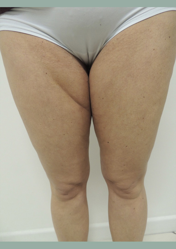 Lipo-corps030-1