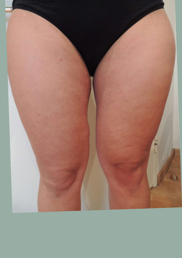 Lipo-corps030-2