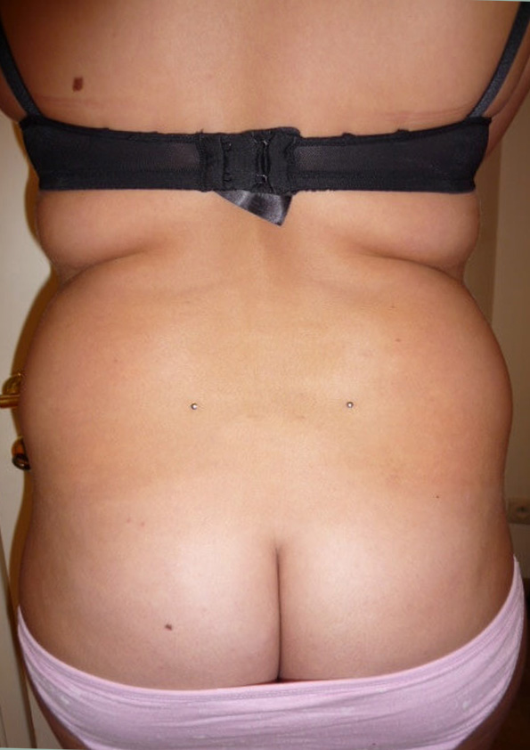 Lipo-corps031-1