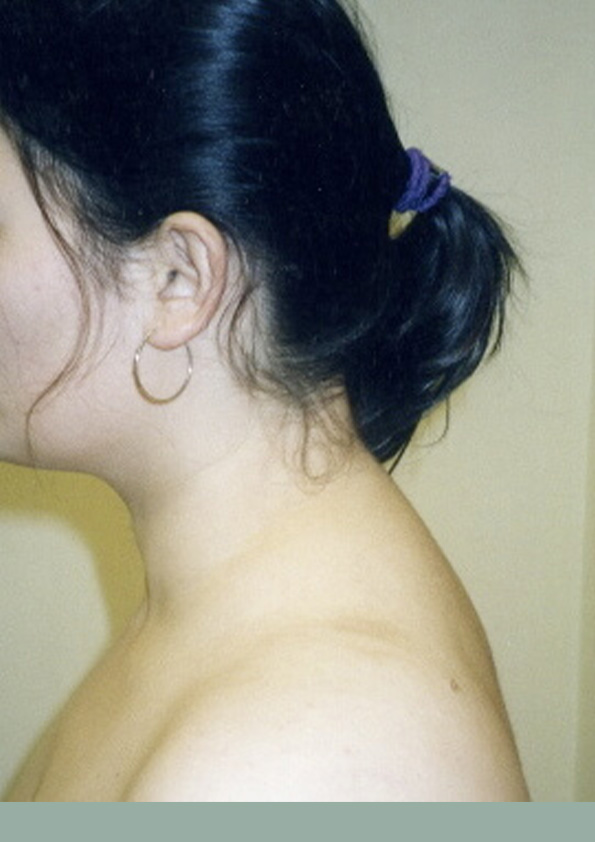 Lipo-corps032-2
