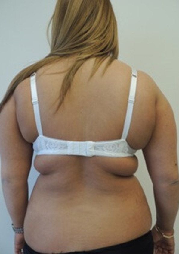 Lipo-corps034-1